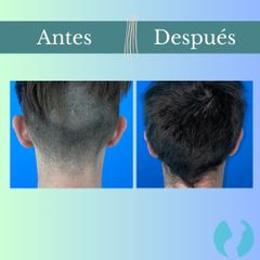 Otoplastia - Clinica Essenza