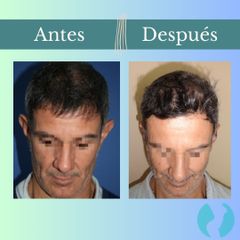 Otoplastia - Clinica Essenza