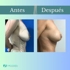 Mastopexia - Dr. Vicente Sánchez Liberona