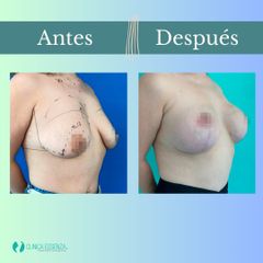 Mastopexia - Dr. Vicente Sánchez Liberona