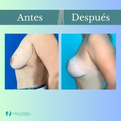 Mastopexia - Dr. Vicente Sánchez Liberona