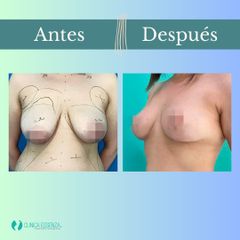 Mastopexia - Dr. Vicente Sánchez Liberona