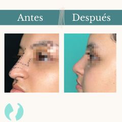 Rinoplastia - Dr. Vicente Sánchez Liberona