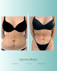 Lipoescultura - Dr. Vicente Sánchez Liberona