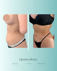 Lipoescultura - Dr. Vicente Sánchez Liberona