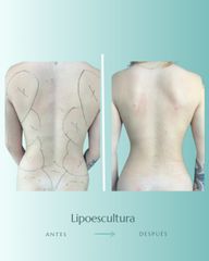 Lipoescultura - Dr. Vicente Sánchez Liberona