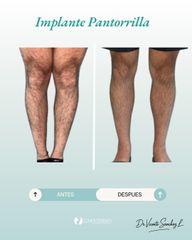 Implante de Pantorrilla - Dr. Vicente Sánchez Liberona