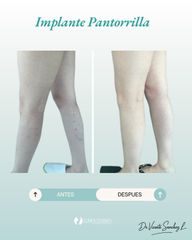 Implante de Pantorrilla - Dr. Vicente Sánchez Liberona