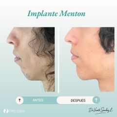 IMPLANTE DE MENTON - Dr. Vicente Sánchez Liberona