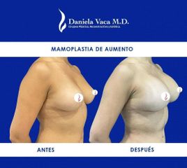 Mamoplastia de aumento - Dra. Daniela Stephania Vaca Grisales