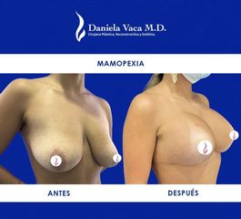 Mamopexia - Dra. Daniela Stephania Vaca Grisales