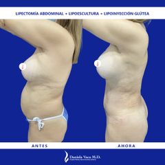 Lipectomía - Dra. Daniela Stephania Vaca Grisales