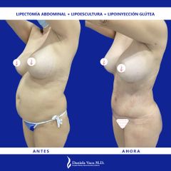 Lipectomía - Dra. Daniela Stephania Vaca Grisales
