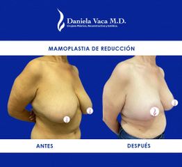 Mamoplastia de reducción - Dra. Daniela Stephania Vaca Grisales