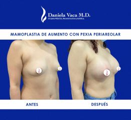 Mamoplastia de aumento - Dra. Daniela Stephania Vaca Grisales