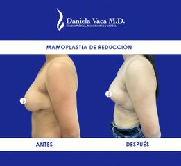 Mamoplastia de reducción - Dra. Daniela Stephania Vaca Grisales