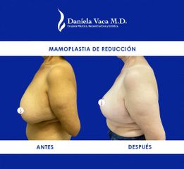 Mamoplastia de reducción - Dra. Daniela Stephania Vaca Grisales