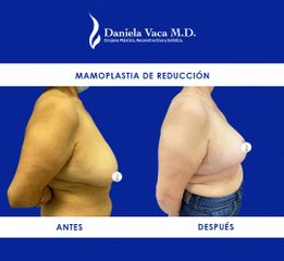 Mamoplastia de reducción - Dra. Daniela Stephania Vaca Grisales