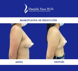 Mamoplastia de reducción - Dra. Daniela Stephania Vaca Grisales