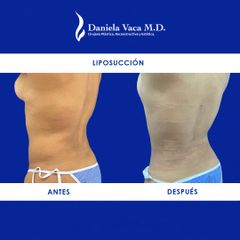Liposucción - Dra. Daniela Stephania Vaca Grisales