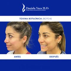 Toxina Botulínica - Dra. Daniela Stephania Vaca Grisales