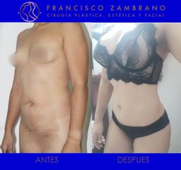 Liposucción, lipectomia y lipoinyección glútea 