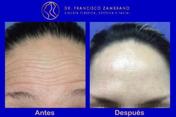 Rejuvenecimiento facial 