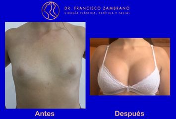 Dr. Francisco Zambrano - Mamoplastia de aumento 