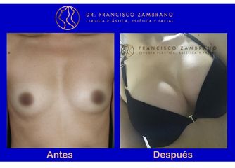 Dr. Francisco Zambrano - Mamoplastia de aumento 