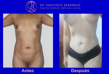 Abdominoplastia con marcacion de abdomen - Dr. Francisco Zambrano