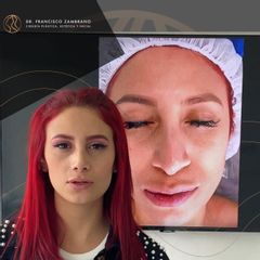 Rinoplastia - Dr. Francisco Zambrano