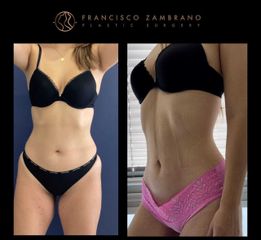 Liposucción - Dr. Francisco Zambrano