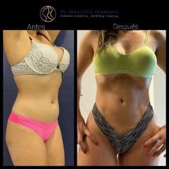 Liposucción - Dr. Francisco Zambrano