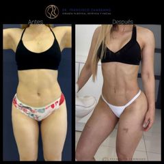 Liposucción - Dr. Francisco Zambrano