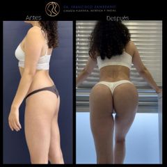 Liposucción - Dr. Francisco Zambrano
