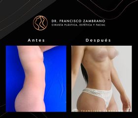 Lipoescultura - Dr. Francisco Zambrano