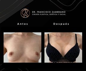 Mamoplastia de Aumento - Dr. Francisco Zambrano