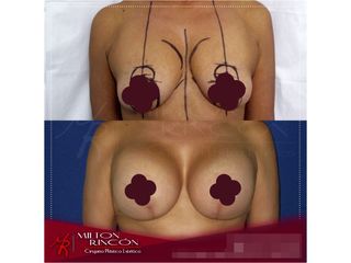 Mamoplastia de aumento