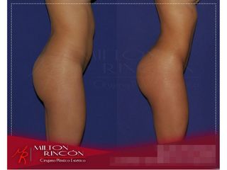 Gluteoplastia