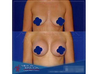 Mamoplastia de aumento