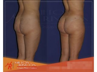 Gluteoplastia