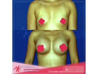 Mamoplastia de aumento