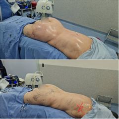 Gluteoplastia - Dr. Milton Rincón Carranza