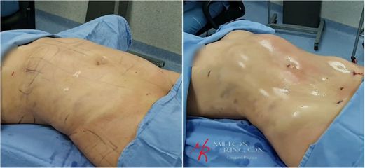 Liposucción - Dr. Milton Rincón Carranza