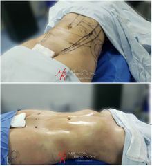Liposucción - Dr. Milton Rincón Carranza