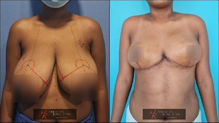 Mamoplastia de reducción - Dr. Milton Rincón Carranza