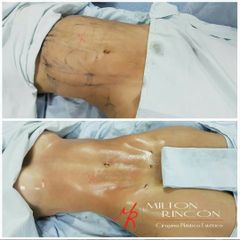 Liposucción - Dr. Milton Rincón Carranza