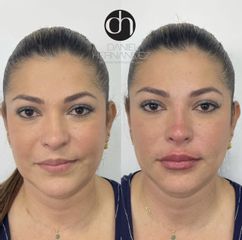 Aumento de labios - Dr. Daniel Hernández