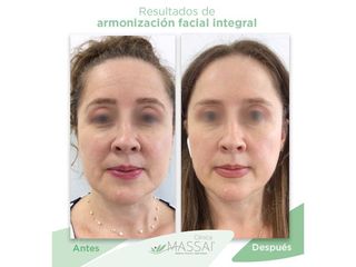 Armonización Facial integral - Massai