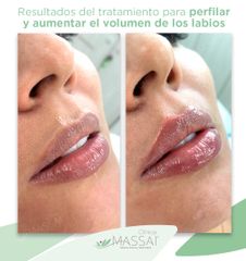 Aumento de labios - Massai Clínica